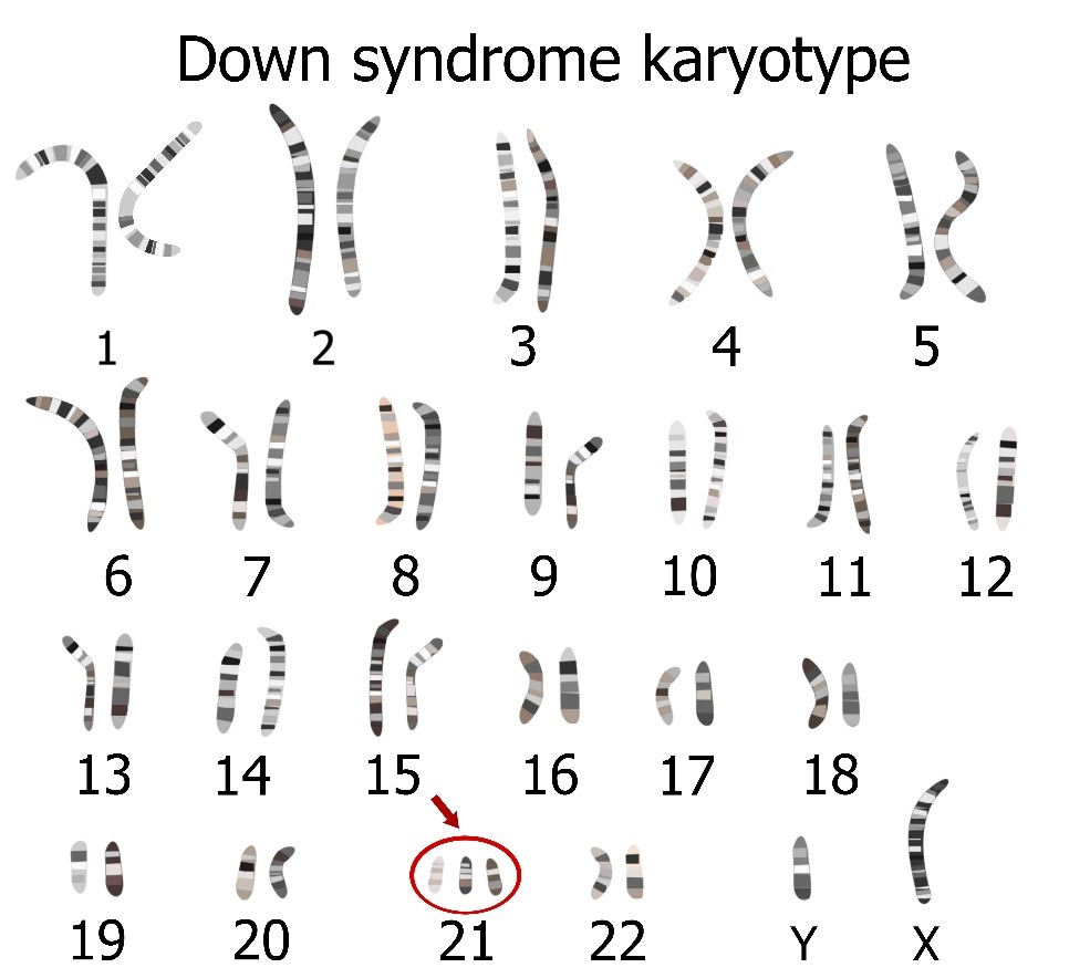 trissomia down