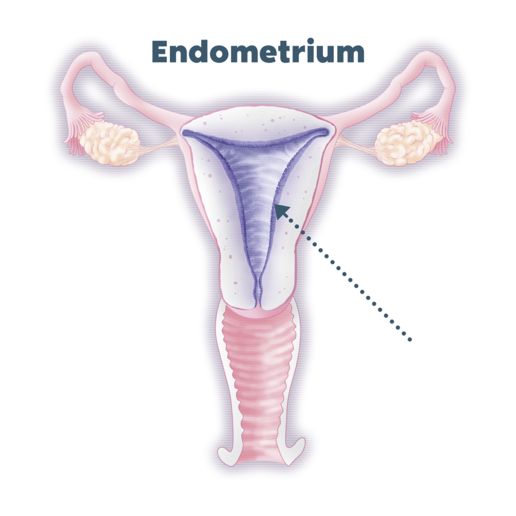 Endometrite: o que é?