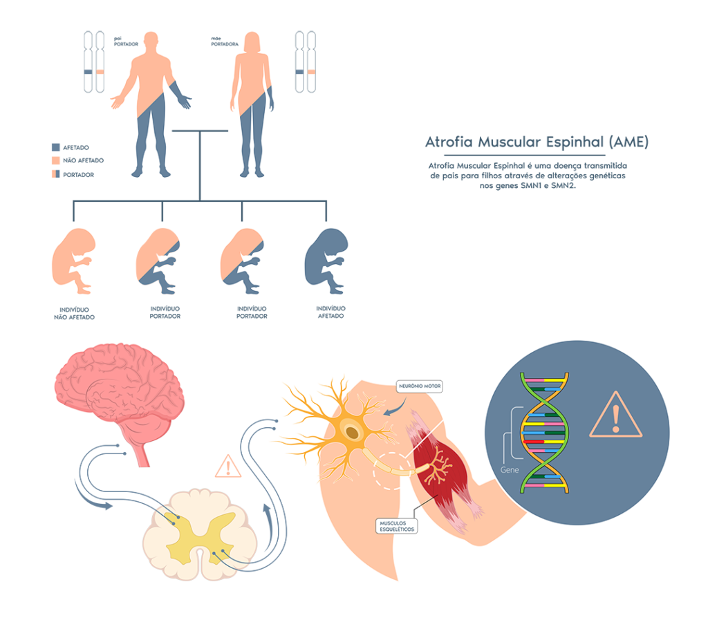 Atrofia Muscular Espinhal - AME