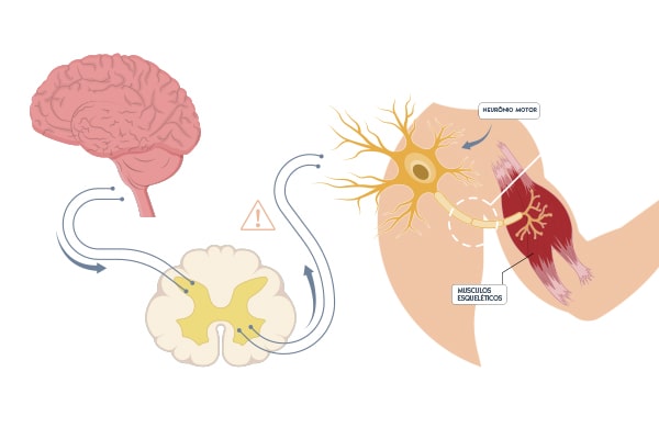 Atrofia Muscular Espinhal: conheça a doença - Blog Mendelics