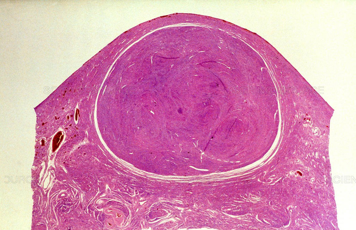 tumor uterino