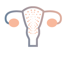 endometrio